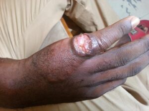 A patient diagnosed with Cutaneous Leishmaniasis