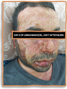 Day 0 of using MaxioCel, day 7 after burn