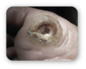 Diabetic Foot Ulcer